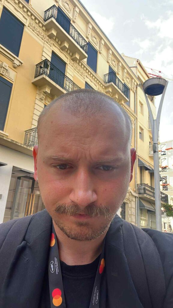 transplant de păr, implant de păr